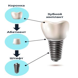 зубной имплант